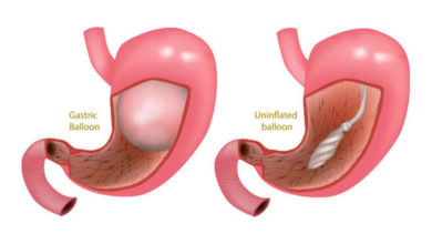 بالون المعدة في الخبر